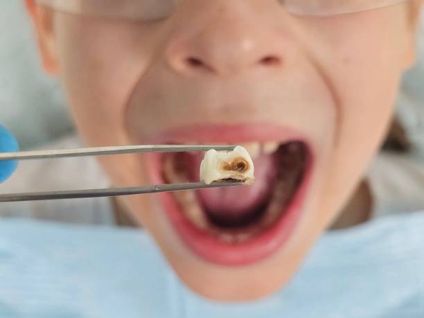 Best Emergency Tooth Extraction in Reed Creek, GA